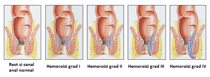 Hemoroizii